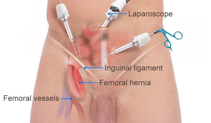 Femoral hernia repair